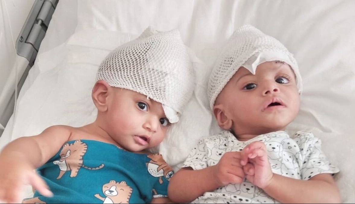 دوقلوهای نادر بعد از ۱۴ ساعت عمل از هم جدا شدند